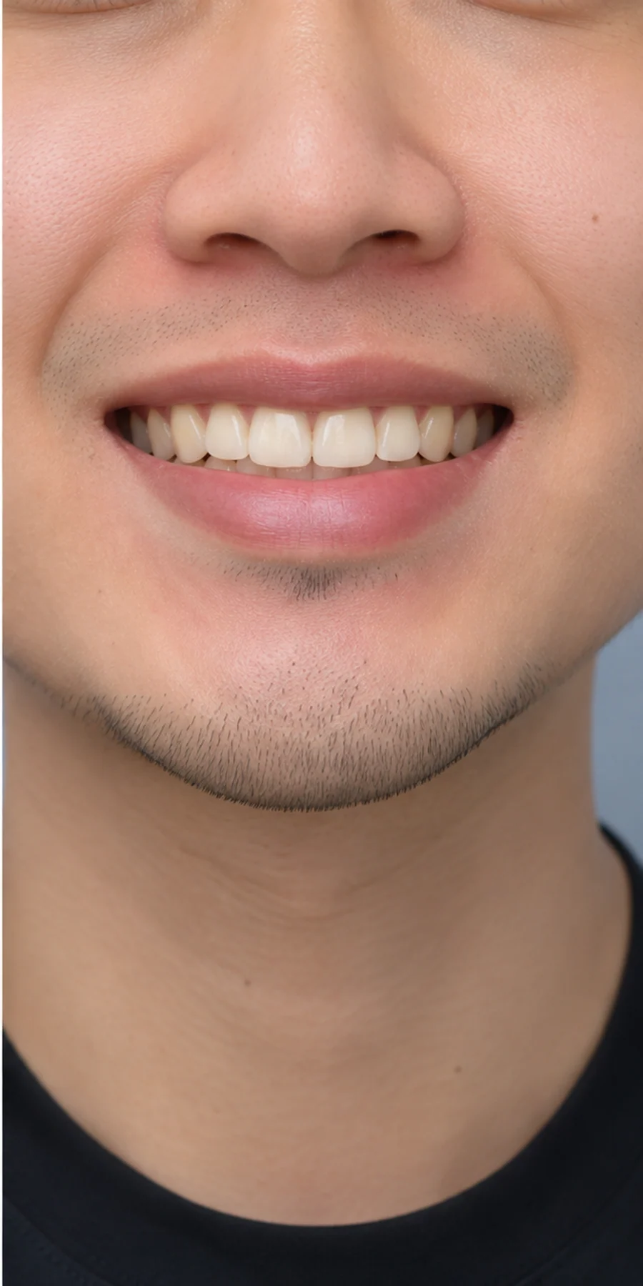 Sau điều trị — Niềng răng trong suốt Invisalign