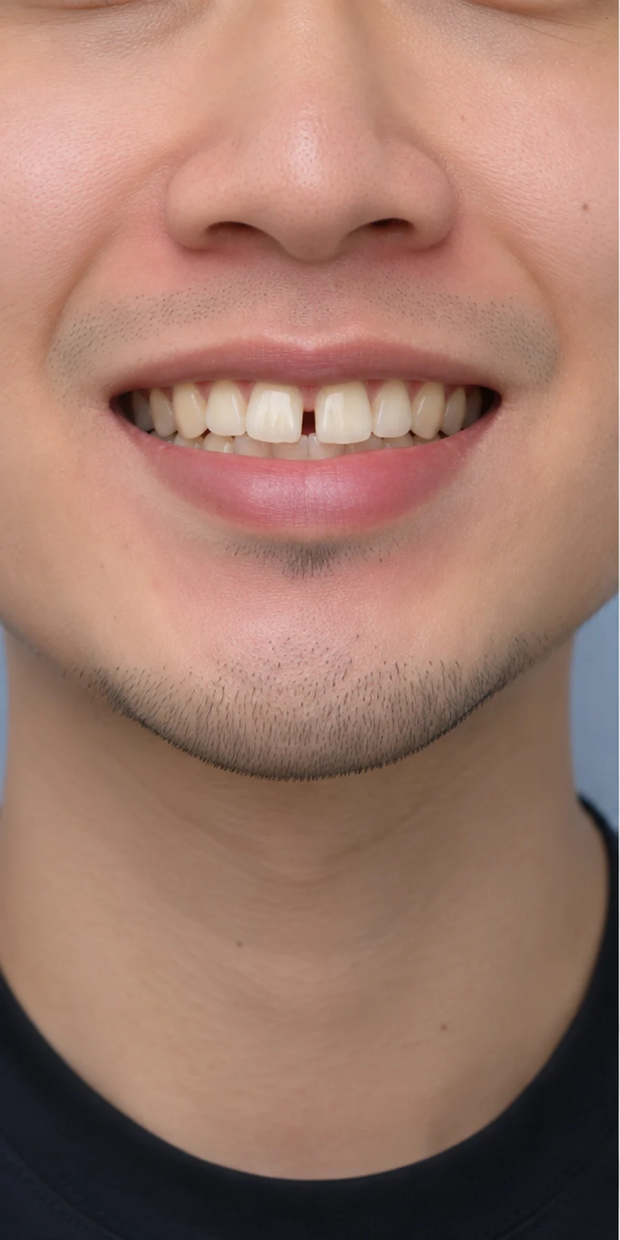 Trước điều trị — Niềng răng trong suốt Invisalign