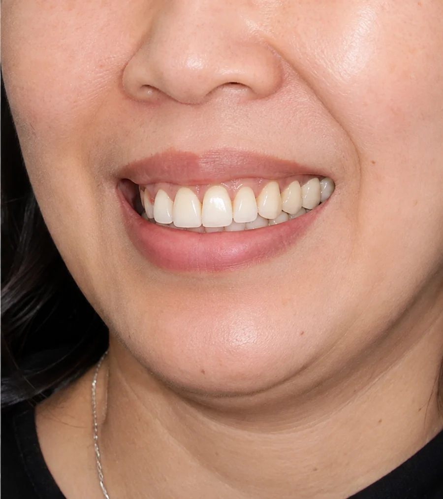 Sau điều trị — Trồng răng Implant (2 trụ)