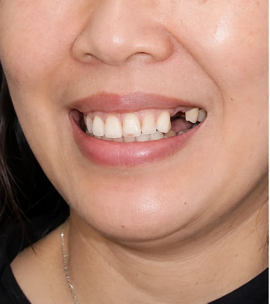 Trước điều trị — Trồng răng Implant (2 trụ)