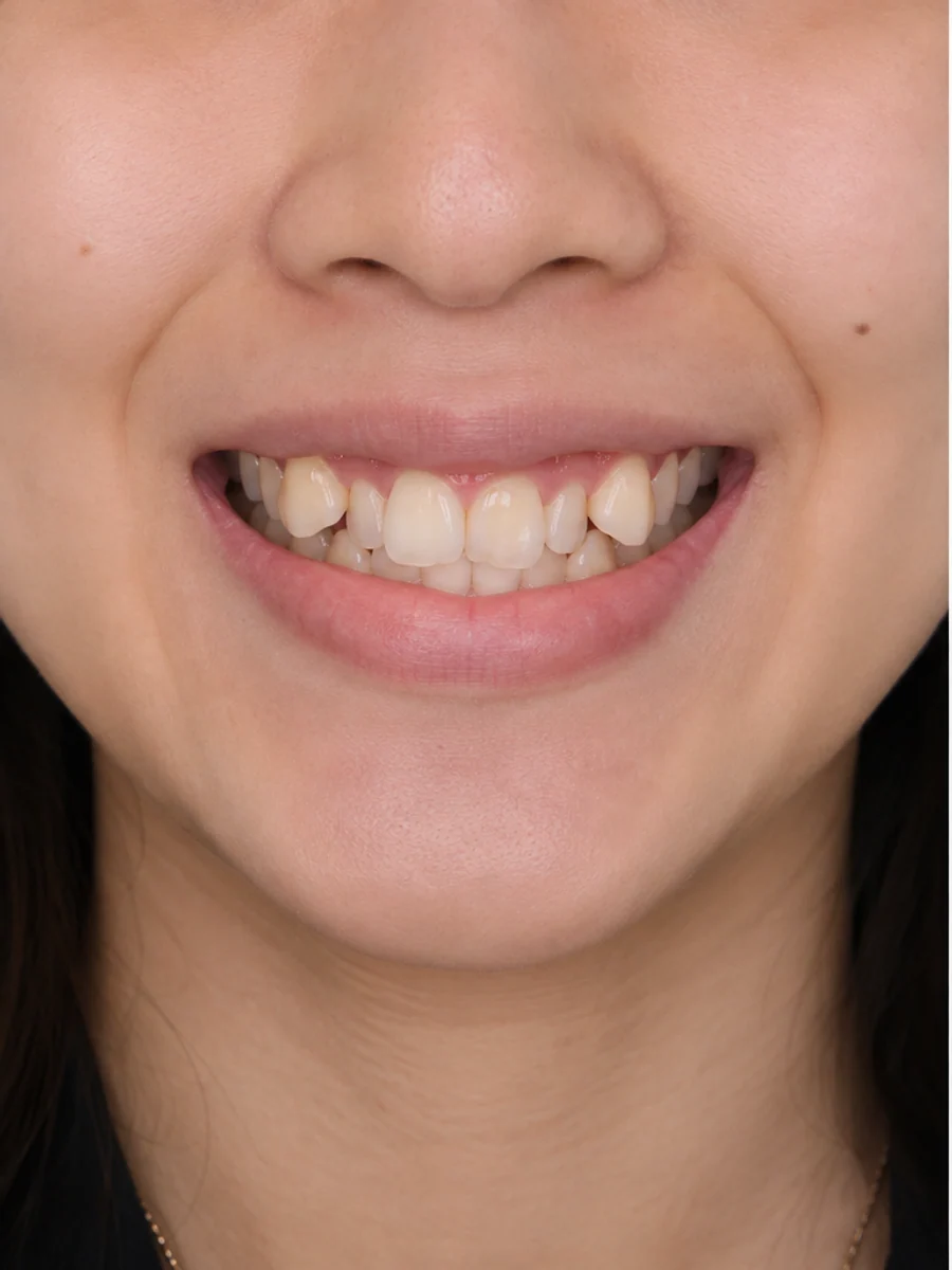 Trước điều trị — Niềng răng mắc cài sứ