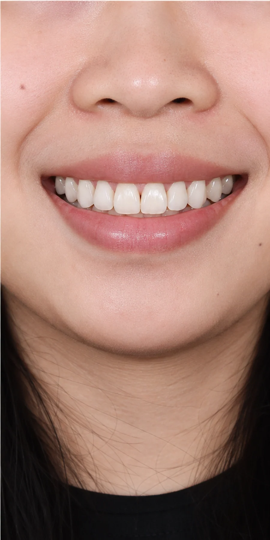Sau điều trị — Tẩy trắng răng công nghệ ánh sáng lạnh