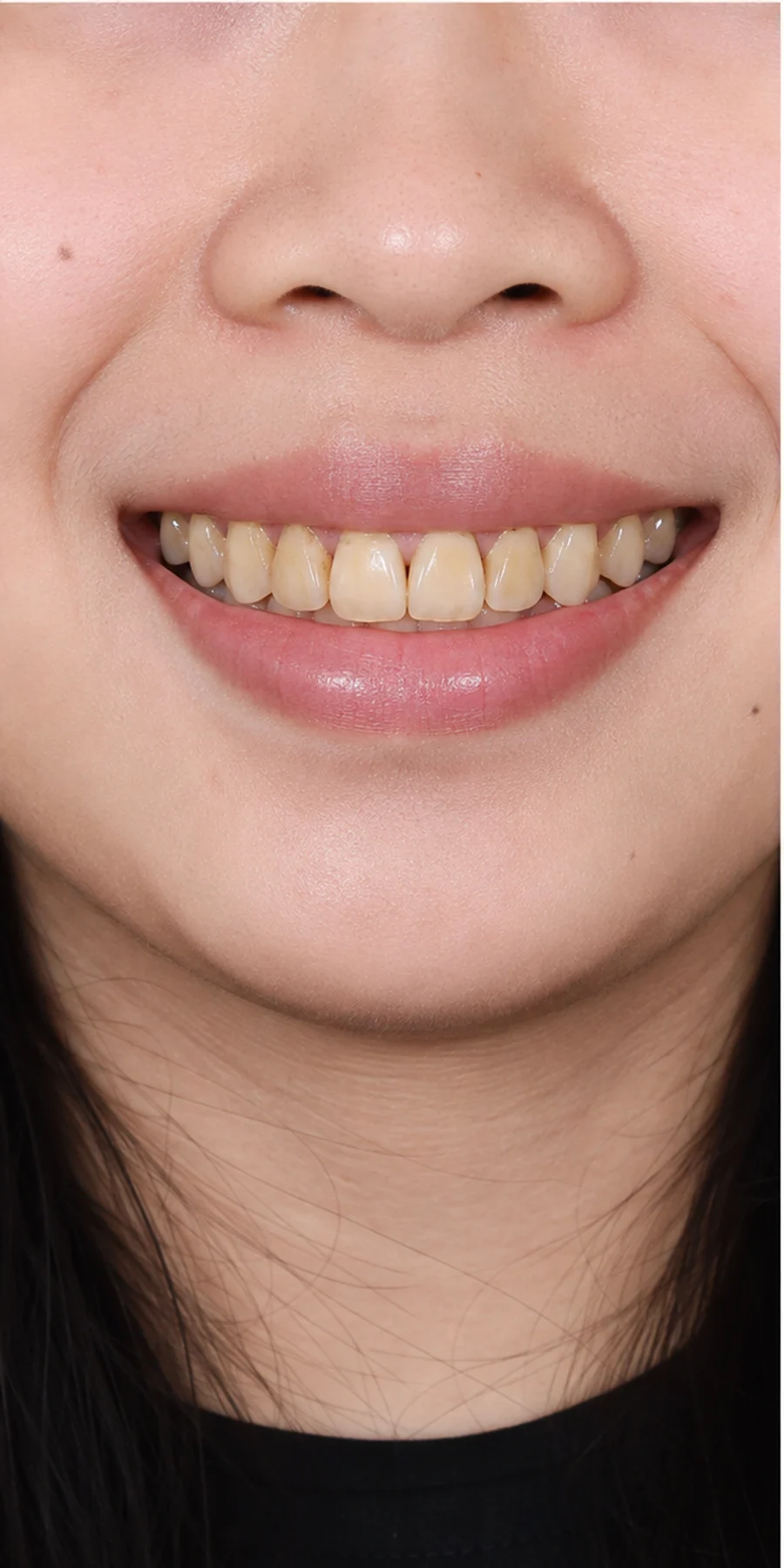 Trước điều trị — Tẩy trắng răng công nghệ ánh sáng lạnh